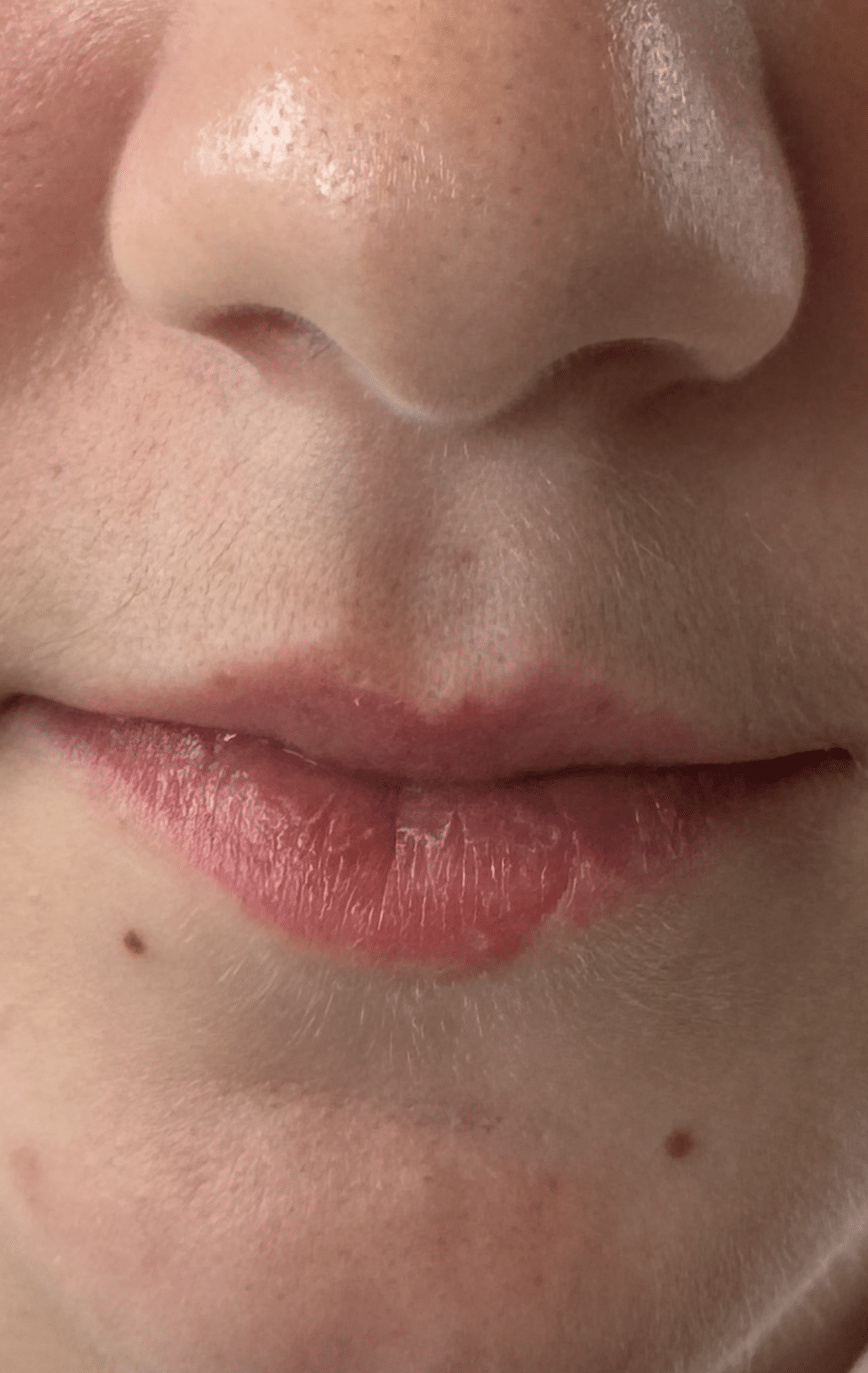 Before Image: Restylane Kysse Lip Filler on Lips w/Scarring - front